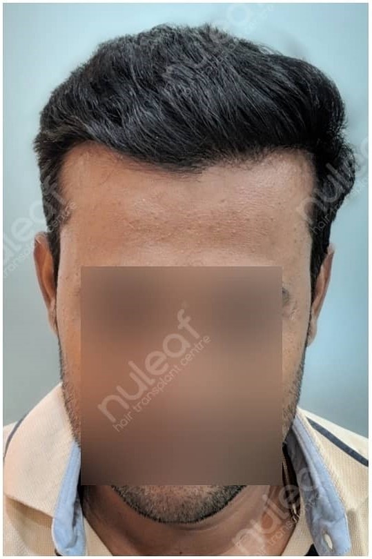 before-after