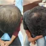 Before and After
