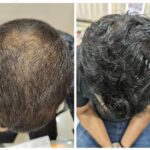 PRP Hair Treatment