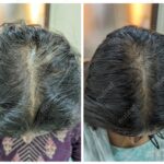 Female Pattern Hair Loss