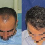 High Grade Hair Loss