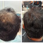 Crown Area Hair Transplants