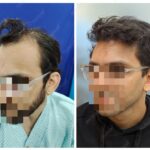 Frontal Area Hair Transplant