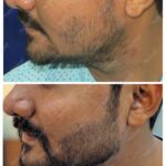 Beard Hair Transplant